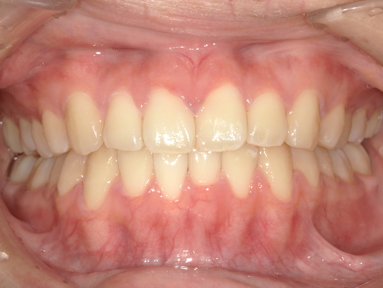 部分矯正の症例