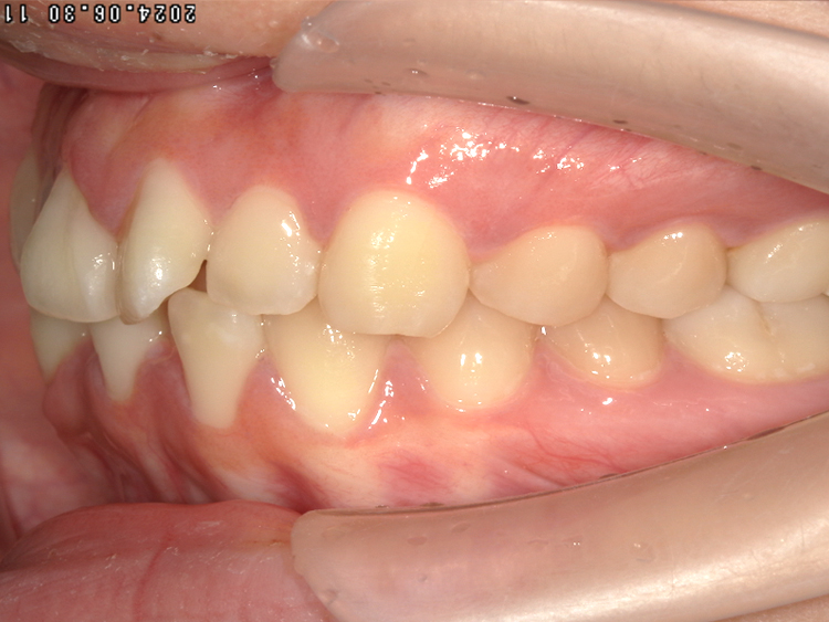 部分矯正の症例