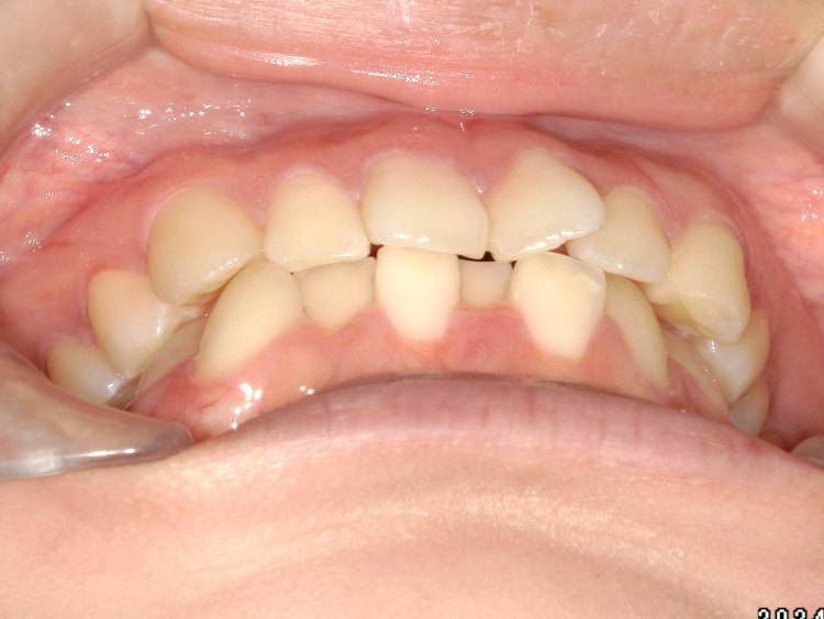 部分矯正の症例