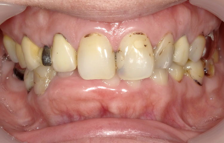 審美治療の症例写真